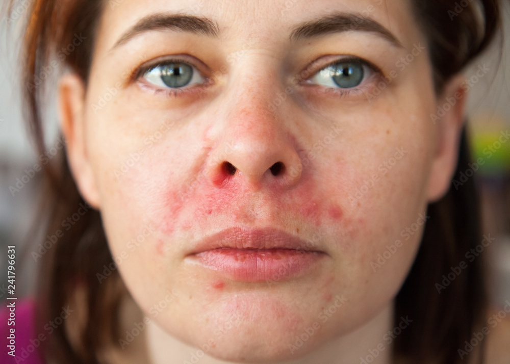 Naklejka premium twarz kobiety z perioralnym zapaleniem skóry
