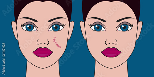 Removal of scars from face