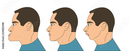 Mesial and distral bite illustration