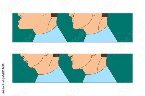 Mesial and distral bite