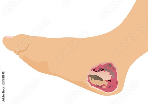 Acinetobacter Infection