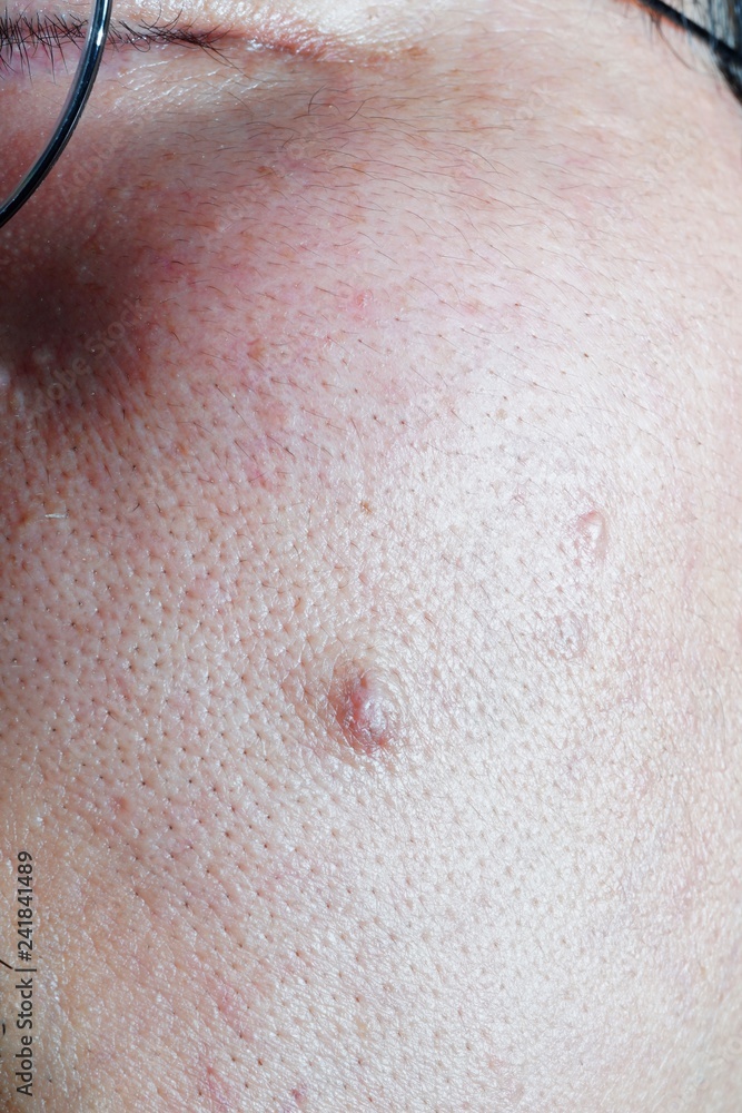 Fototapeta premium Wart on the skin