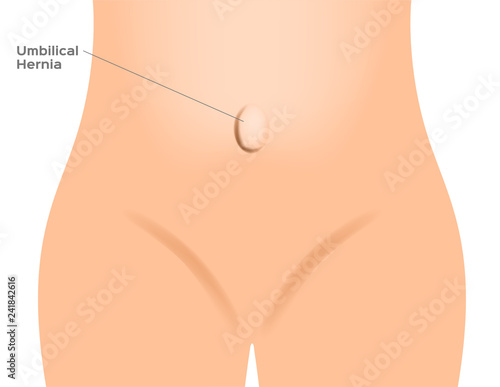 umbilical hernia / intestine / human anatomy / belly vector