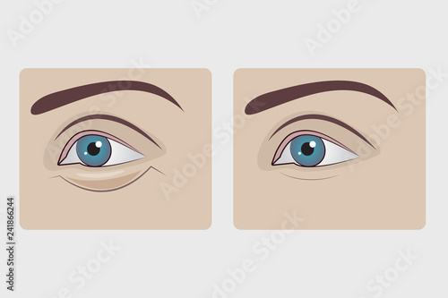 Bags under eyes