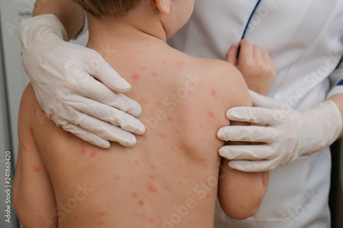 Schilderij op canvas Doctor examines baby's skin full of blisters,scar and rash caused by chicken pox