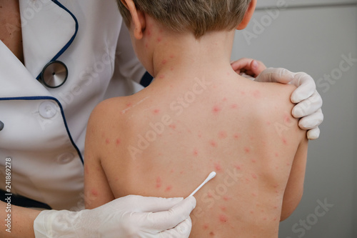 Doctor applying cream to baby s skin with blisters and rash caused by chickenpox