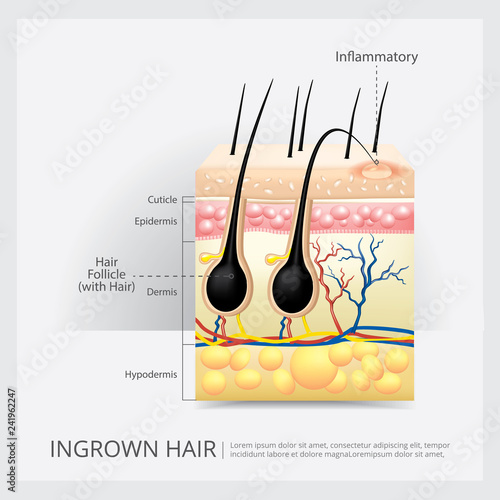 Ingrown Hair Structure Vector Illustration