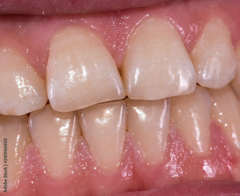 Healthy human teeth - incisors, frontal close up view
