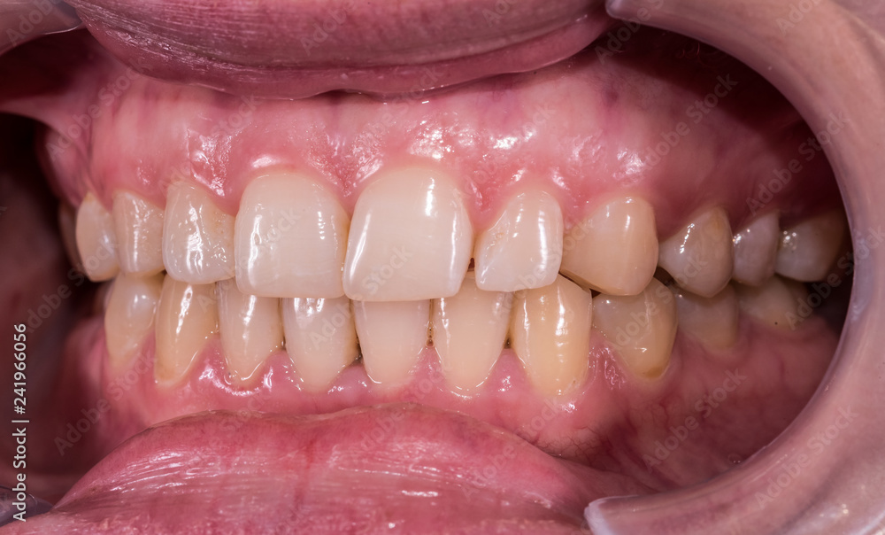 Healthy human teeth with normal occlusion from side view