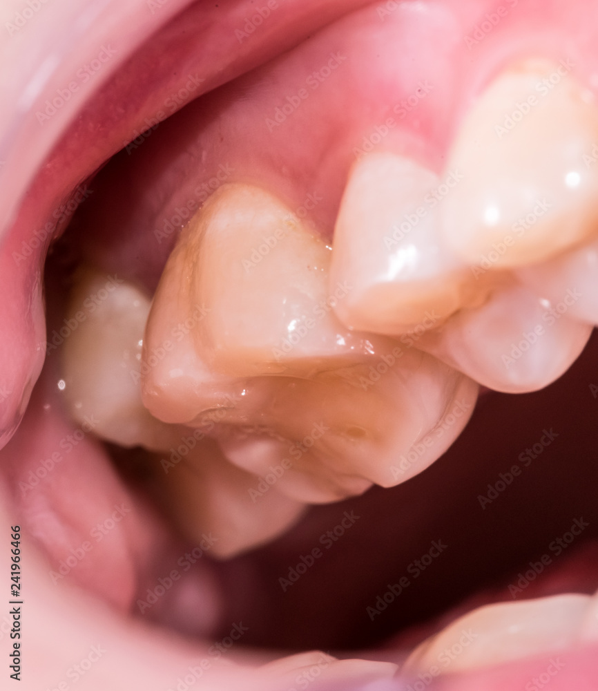 Healthy human molar teeth close up view Healthy human molar teeth close up view