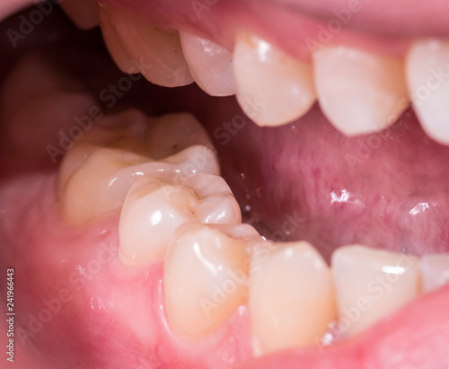 Healthy human molar teeth close up view