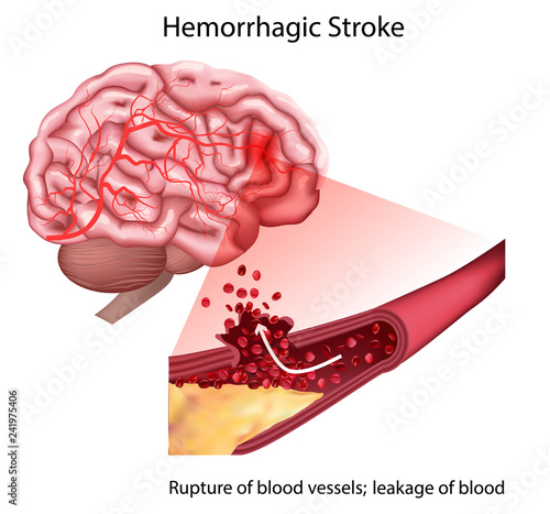 Stroke types poster, banner. Vector medical illustration. white background, anatomy image of damaged human brain, blocked and ruptured blood vessels.