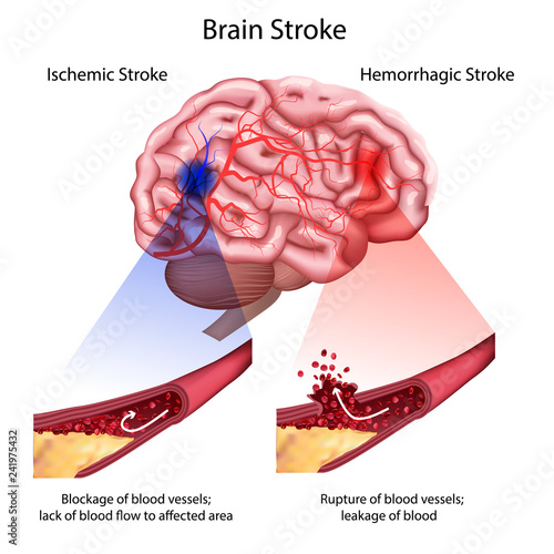 Stroke types poster, banner. Vector medical illustration. white background, anatomy image of damaged human brain, blocked and ruptured blood vessels.