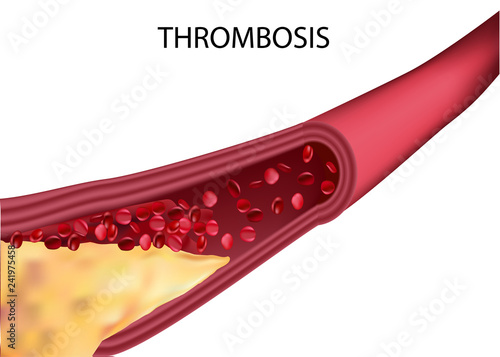 Blocked blood vessel - artery with cholesterol buildup realistic vector illustration isolated background