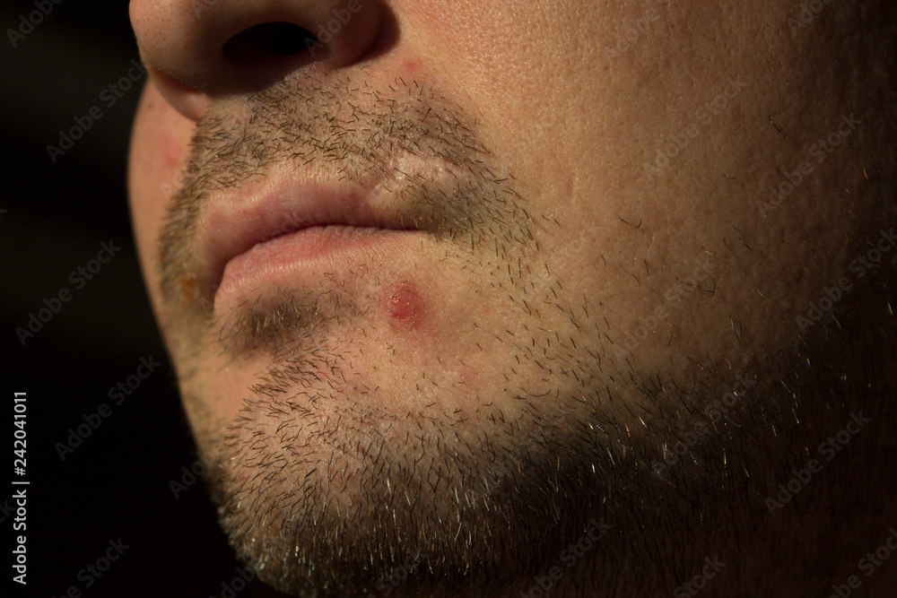 Obraz premium Acne inflammation on young skin and care for it