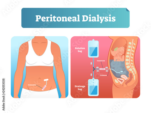 Peritoneal dialysis vector illustration. Labeled method to exchange fluids.