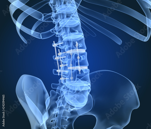 Spinal fixation system - titanium bracket. X-Ray 3D illustration
