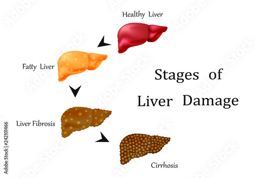 Stages of liver damage, liver disease. Healthy, fatty, liver fibrosis and cirrhosis isolated on white background.Round diagram.Vector illustration photo