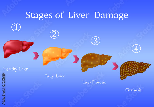 Stages of liver damage, liver disease. Healthy, fatty, liver fibrosis and cirrhosis isolated on blue background.Vector illustration