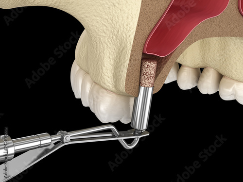 Sinus Lift Surgery - Adding new bone. 3D illustration photo