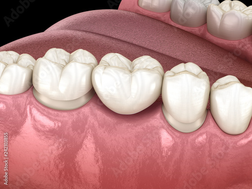 Fototapeta Naklejka Na Ścianę i Meble -  Dental bridge of 3 teeth over molar and premolar. Medically accurate 3D illustration of human teeth treatment