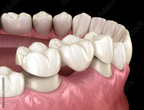 Most dentystyczny 3 zębów nad zębem trzonowym i przedtrzonowym. Medycznie dokładna ilustracja 3D leczenia ludzkich zębów