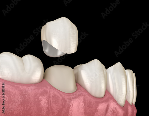 Fototapeta Naklejka Na Ścianę i Meble -  Dental crown premolar tooth assembly process. Medically accurate 3D illustration of human teeth treatment