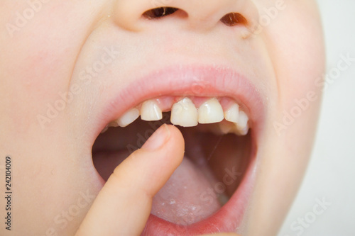 The baby girl smiling and shaking wobbly milk tooth in open mouth with her finger. First molar teeth. Health care, dental hygiene and childhood concept