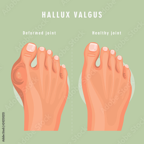 Hallux valgus vector medicine poster. Colorful design. Detailed image with text.