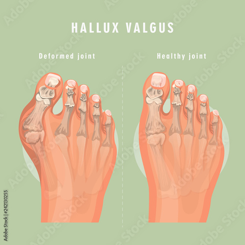 Hallux valgus vector medicine poster. Colorful design. Detailed image with text.