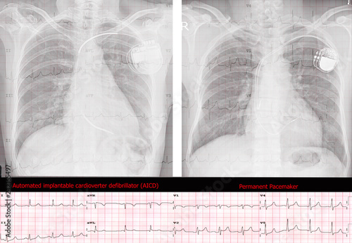Automated implantable cardioverter defibrillator (AICD) and Permanent Pacemaker.