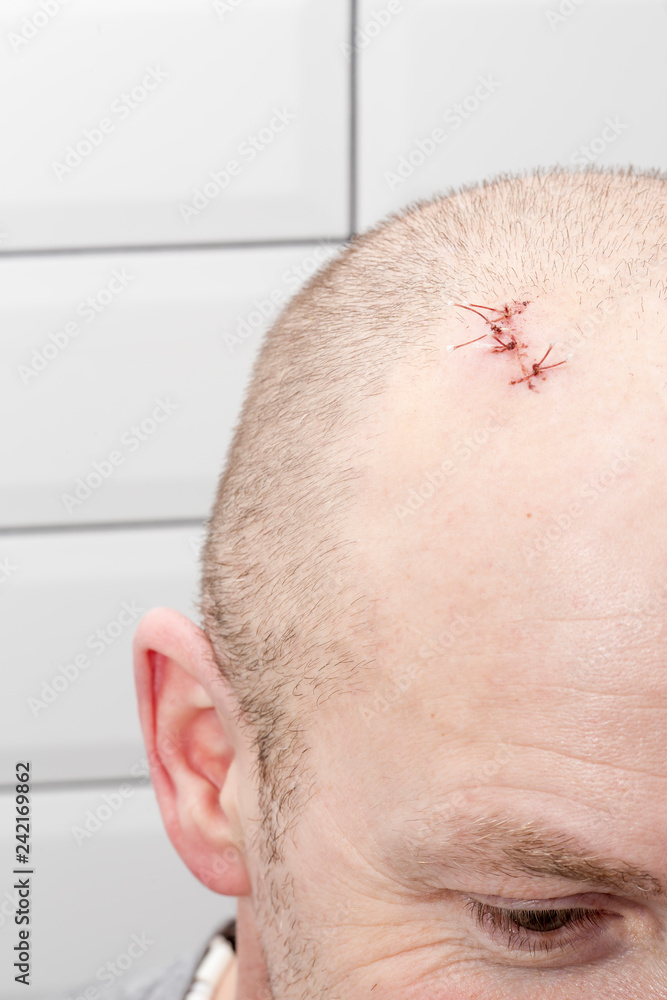 On the man’s head there is a wound with sutures, after injury. Closeup