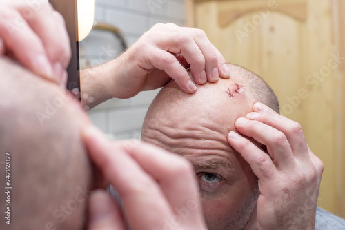 In a mirror reflection, a man examines a wound with sutures on his head. Close-up.