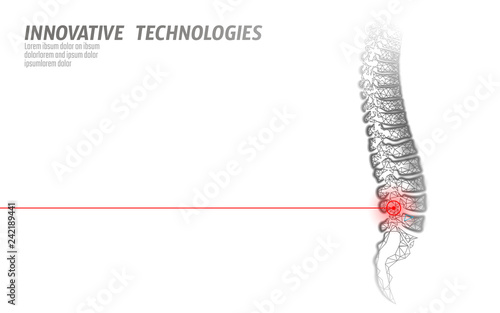 Laser physiotherapy human spine injury. Pain area surgery operation modern loin medicine technology low poly triangles 3D render female back hernia vector illustration