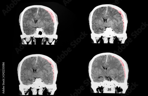 CT brain with large subdural hematoma photo