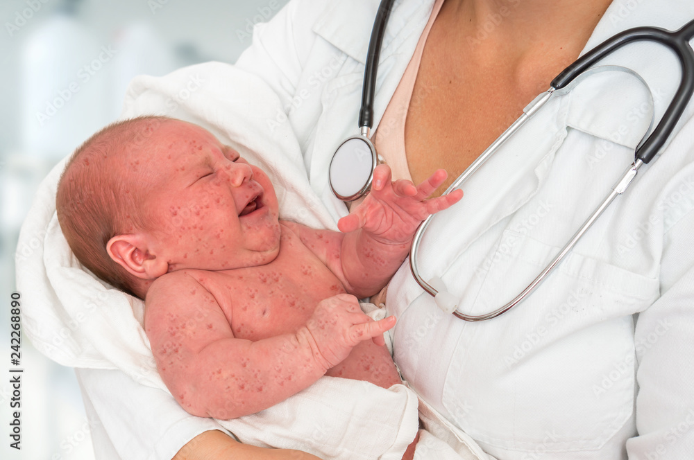 Doctor holding a newborn baby which is sick rubella or measles - obrazy, fototapety, plakaty 