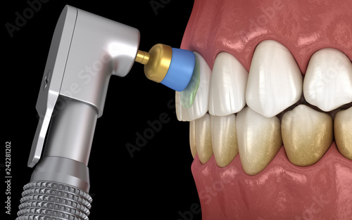 Wallpaper Mural Teeth polishing procedure with professional brush and gel. Medically accurate 3D illustration Torontodigital.ca