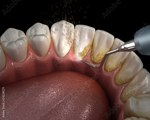 Εκτύπωση καμβά Oral hygiene: Ultrasonic teeth cleaning machine removing calculus and plaque