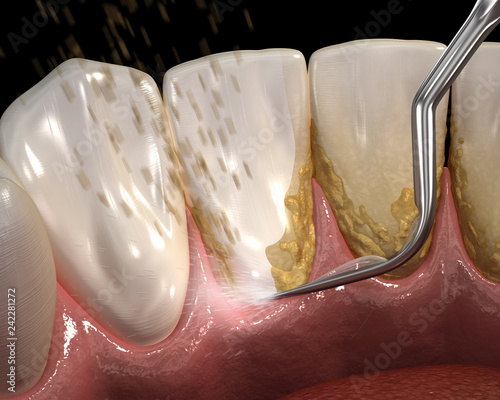 Fototapeta Naklejka Na Ścianę i Meble -  Oral hygiene: Ultrasonic teeth cleaning machine removing calculus and plaque. Medically accurate 3D illustration of human teeth treatment
