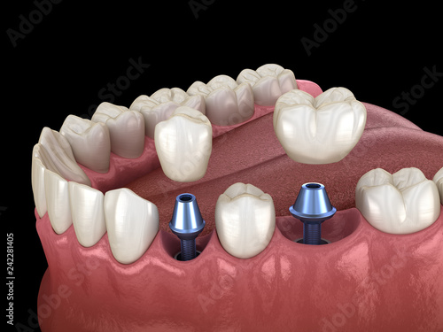 Fototapeta Naklejka Na Ścianę i Meble -  Premolar and Molar tooth crown installation over implant abutments. Medically accurate 3D illustration of human teeth and dentures concept