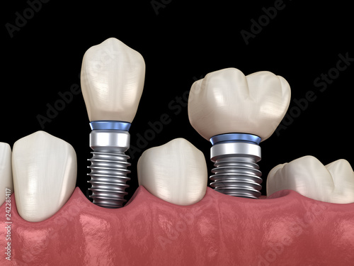 Premolar and Molar tooth crown installation over implant abutments. Medically accurate 3D illustration of human teeth and dentures concept