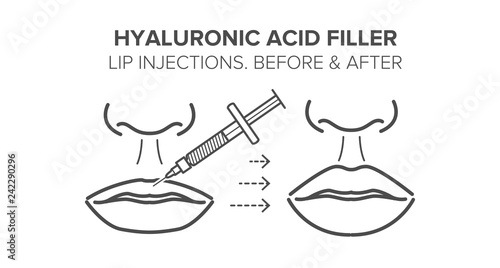 Hyaluronic acid filler. Lip injections. Before and after. Vector illustration