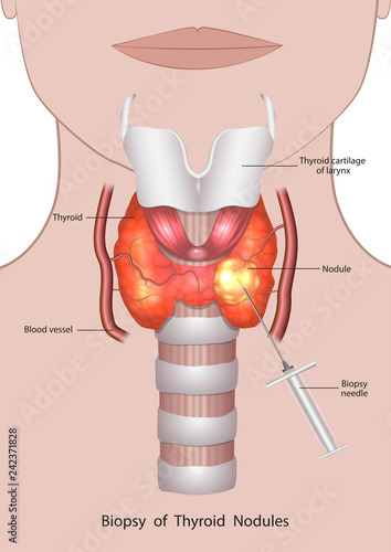 Fluid removal from the thyroid gland with a biopsy needle