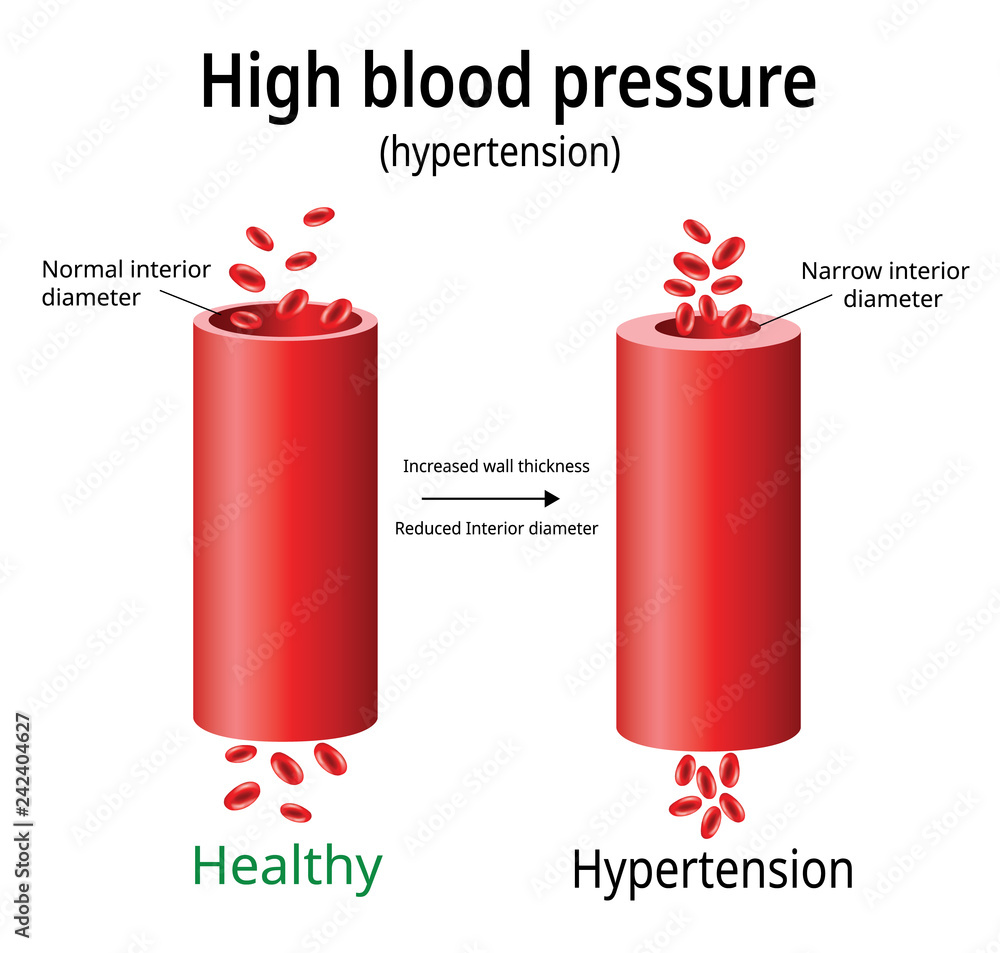 Hypertension, high blood pressure vector, two blood vessels, science ...