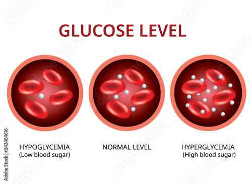 Glucose level in the blood vessel, normal level, hyperglycemia (high blood sugar), hypoglycemia (low blood sugar) Vector Illustration