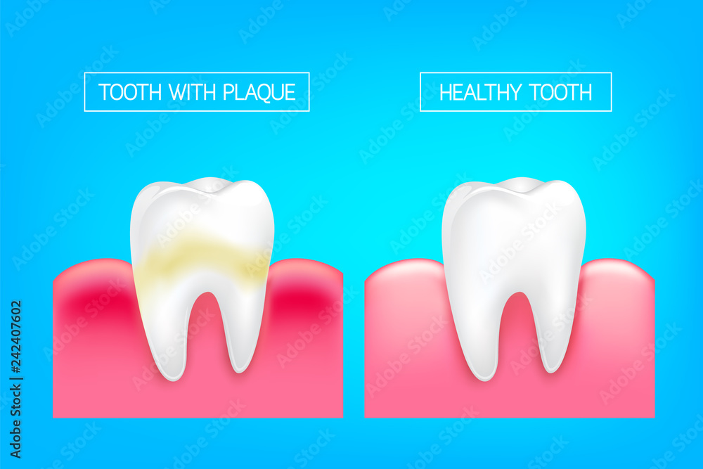 Tooth with plaque and healthy tooth comparision. Teeth Whitening. Dental care Concept. Oral Care, teeth restoration. Yellow and white teeth. Tooth with plaque and healthy tooth comparision. Teeth Whitening. Dental care Concept. Oral Care, teeth restoration. Yellow and white teeth.