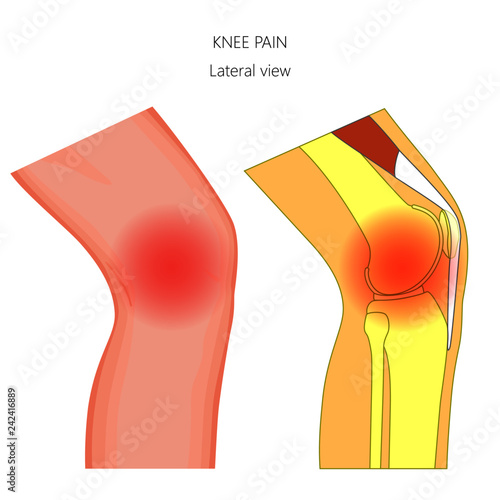 Vector illustration of unhealthy human knee joint with pain in the joint. Anatomy of the knee side, lateral view of the knee.  For advertising and other medical publications
