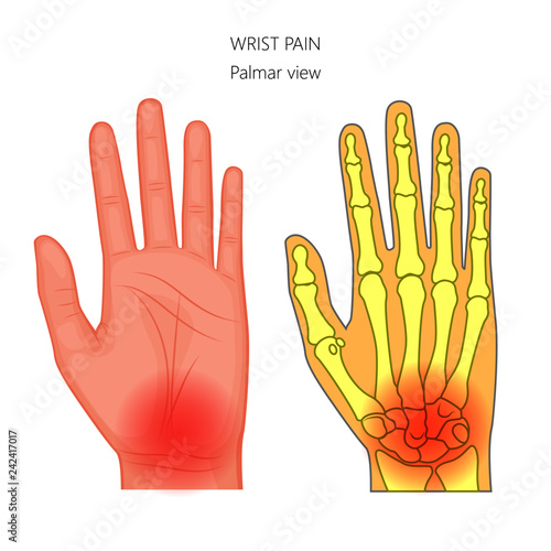 Vector illustration of unhealthy human hand with pain in the wrist. Anatomy of the hand and wrist. Palmar view of the hand. For advertising and other medical publications