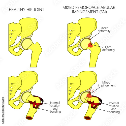Vector illustration of a healthy human hip joint and a hip with mixed femoroacetabular impingement. Front view of hip joint with section of the pelvis. For advertising and medical publications.