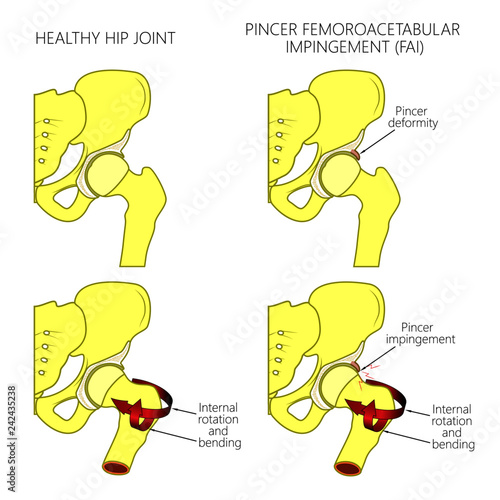 Vector illustration of a healthy human hip joint and a hip with pincer femoroacetabular impingement. Front view of hip joint. For advertising and medical publications.